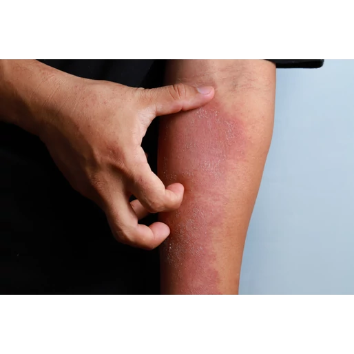 Gyulladásos bőrbetegségek